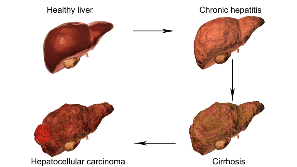 The Stigmata of Chronic Liver Disease: A Medical Perspective