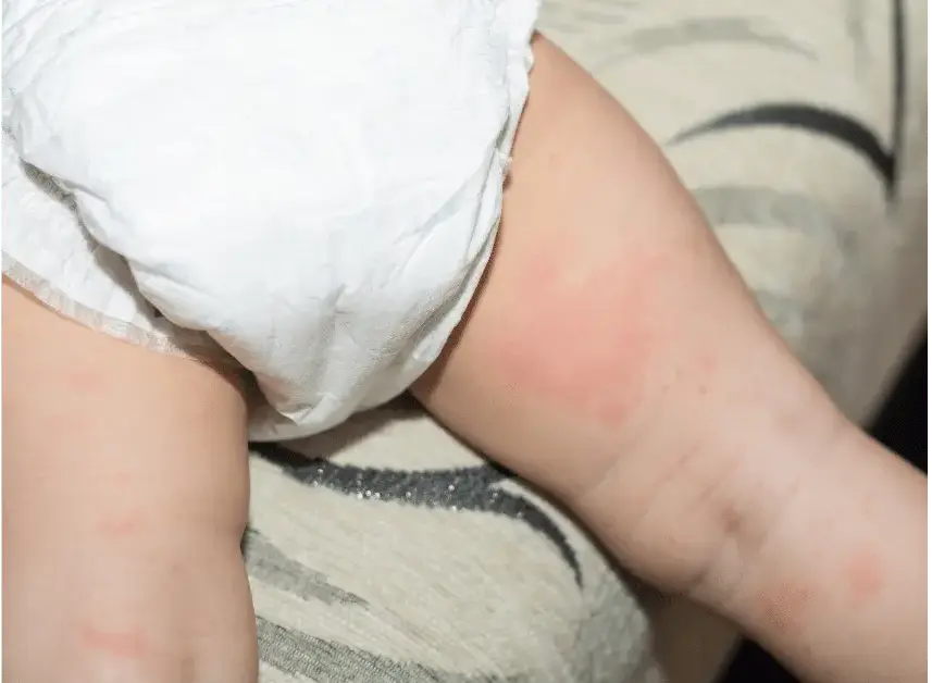 Understanding and Treating Common Baby Rashes: A Parent's Guide
